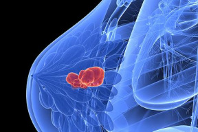 1-3-milionu-zen-chybne-leceno-kvuli-falesne-pozitivnim-vysledkum-z-mamogramu
